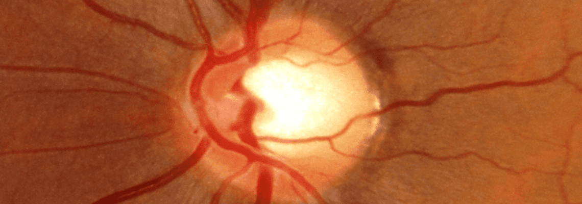 Primary Open Glaucoma (POAG) May Be Genetically Linked to ABO Blood Group