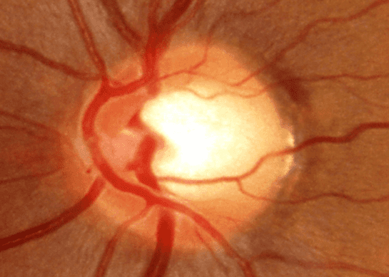 Primary Open Glaucoma (POAG) May Be Genetically Linked to ABO Blood Group