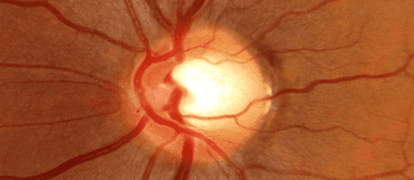 Primary Open Glaucoma (POAG) May Be Genetically Linked to ABO Blood Group